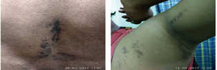  Figure 2 Hyperkeratotic violaceous itchy plaques on backside and  one side of left axilla.