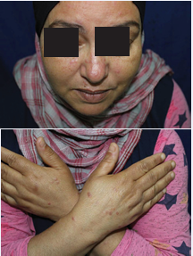 Papules and purple scars on the face and hands (Sarcoidosis).