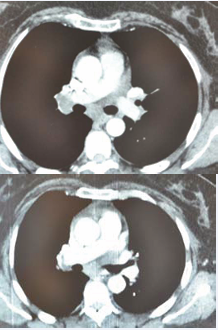 A comparison of regression of the size of mediastinal  lymphadenopathy between 2017 and 2018.