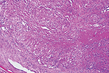  Figure 3 Granulomatous structures with central caseiting necrosis.