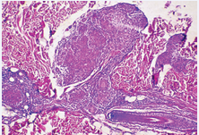Granulomatous structures without central necrosis.