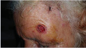 Ulcerated tumor with beaded edges surmounted by an  erythematous lesion with an ulcerated an scabby center (biopsied).