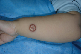Rash of the left forearm, with a red flat-topped plaque and a  yellowish, keratotic center and thin scales
