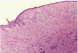 Histopathologic findings of under low-power magnification  (hematoxylin-eosin, original magnification ×40), low-powered  histological view showing epidermal hyperkeratosis (red arrow).