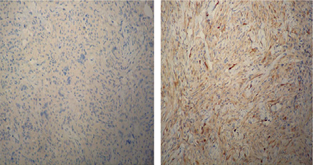 The histiocytic cells were negative for CD1a (Left) and S100  (Right) by immunohistochemical staining.