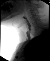 Figure 2 Modified barium swallow showing tracheoesophageal fistula with complete pharyngoesophageal stenosis and demonstrating aspiration of the entire bolus.
