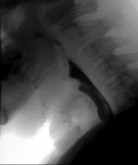 Figure 8 Postoperative modified barium swallow showing a widely patent pharyngoesophageal reconstruction without evidence of a leak or fistula.