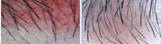 shows the hair analyzer magnification of the  eyebrow at baseline (1) and at week-12 (2) for the subject. Compared  to the baseline scan, the scan at week=12 shows a significant increase  in the number of new hair follicles. There was also an increase in the  length of the individual hair and its overall thickness based on the  photograph from the scan.