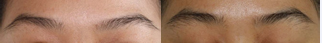 shows the changes in eyebrow density based on  digital photography. There was a clinical improvement in the density  of the eyebrow thickness from baseline to week-12 of the clinical  study.