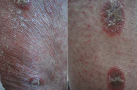 Psoriasiform plaques with erythema and scales.