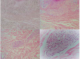  Figure 3 A. Histopathological examination showed epidermis with  acanthosis and spongiosis, in the superficial dermis a moderate  perivascular lymphohistiocytic infiltrate. (Hematoxylin-eosin stain  20x). B.- In the superficial and middle dermis, the inflammatory  infiltrate was nodular, around the nerves, annexes, and the blood  vessels, with vacuolated histiocytic cells. (Hematoxylin-eosin stain  20x).