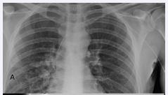 Figure 1 A, B: During attempted removal after 7 weeks of antibiotic therapy, PICC line was withdrawn from central position (A) but could not be removed beyond upper left brachial vein (arrow, B). C-Case 1: Twelve hours after instillation of tPA, PICC line could be easily removed along with section of fibrin sheath still adherent to distal third of catheter.