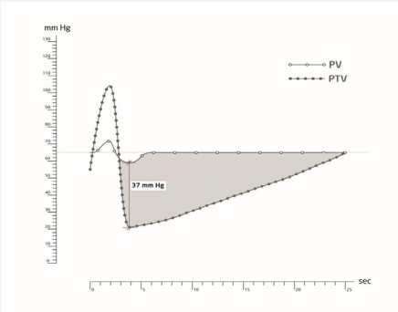 Figure 1 Schematic illustration of the overlapping of the systolic and diastolic pressure curves in the posterior tibial vein and in the popliteal vein at the end of the calf pump activity. Whereas the pressure excursions in the posterior tibial vein are very marked, the excursions in the popliteal vein are minimal. The darker area showcases the ambulatory pressure gradient, which arises after the end of calf pump activity. PV = popliteal vein, PTV = posterior tibial vein.