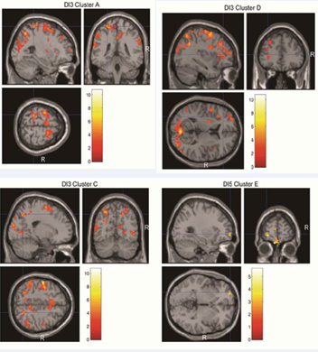 3-digit wmem, widespread FWE-corrected significant activation was  found in portions of the bilateral superior and mid frontal cortex, supplementary  motor area and pre and post central gyrus, bilateral superior and inferior  parietal lobule, and inferolateral pre-frontal cortex, cuneus, insula and cingulate  regions (see DI3 Clusters A, C, and D). 5 digit wmen, positive activation was seen  in the inferior medial frontal and medial orbitofrontal cortex (DI5 Cluster E).