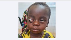 Figure 1 Image showing non-axial right exophthalmos with palpebral malocclusion.