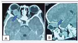 Figure 2: Cerebral CT scan in parenchymal window with injection of contrast medium in axial section (A) and sagittal section (B) showing a right intra conical tumor mass indicated by the blue arrow.