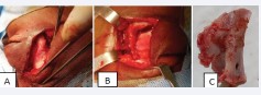 Figure 4: Images (A, B, C) showing a right lateral osteotomy