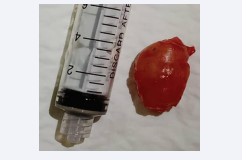Figure 5: Image showing monobloc tumor resection.
