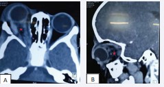 Figure 6: Parenchymal CT scan of the brain with contrast injection in axial section (A) and sagittal section (B) on D1 post-op, showing an empty tumour bed indicated by the red star.