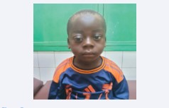 Figure 7: Image showing a post-operative check-up at 12 months, showing a significant reduction in right exophthalmos.