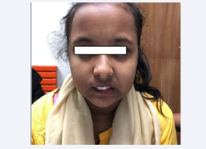 13 year girl with facial nerve palsy of right side.