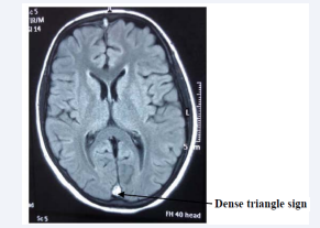 MRI of brain: Dense triangle sign.