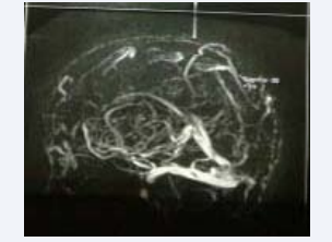MRV: non visualized superior sagittal sinus, right transverse sinus  and both sigmoid sinuses suggestive of thrombotic occlusion.