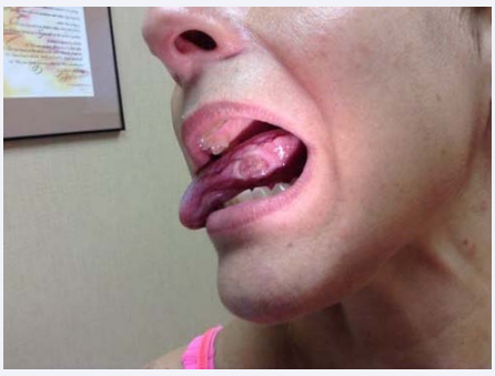 Figure 1 Large Behçet’s ulceration on the tongue.