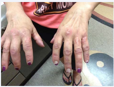 Figure 2 Granulomas and swelling of the joints (before Minocycline, Rifampin and Pyrazinamide).
