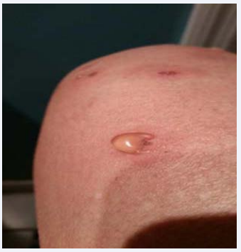 Figure 3 Papulo-pustular lesions