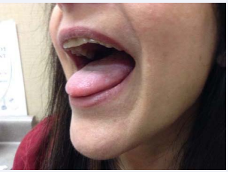 Figure 4 Clearing of tongue ulcers.