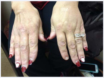 Figure 5 Decreased joint pain/granulomas.