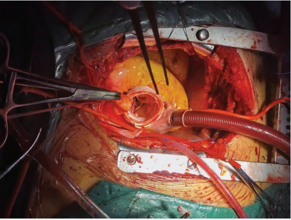 Completion of root treatment.