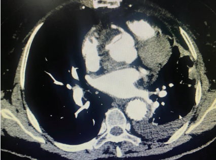 Residual entrapment in the sinus of the aorta.