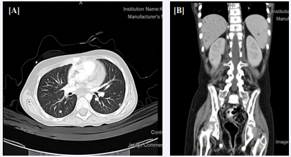 (A) Chest CT scan chest showing tiny pulmonary nodules are noticed one in the left lower lung. (B) Abdominal CT with contrast of showing numerous nodules in the liver, spleen and kidneys.