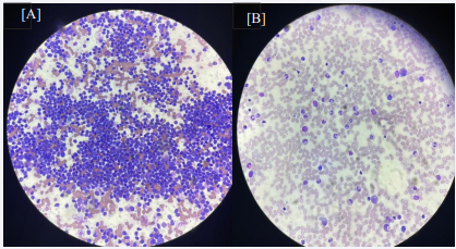 (A) Ultrasound Guided Biopsy of liver nodules showing hyphae with septate (possible Aspergillus). (B) Biopsy of liver nodules after fungal treatment..