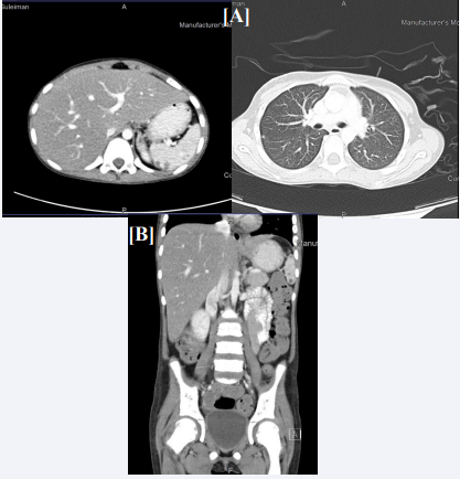 (A) Chest CT scan chest showing tiny pulmonary nodules are noticed one in the left lower lung. (B) Abdominal CT with contrast showing numerous nodules in the liver, spleen and kidneys.